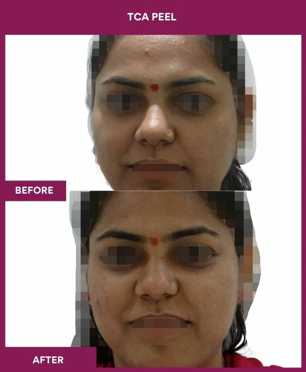 tca-peel-treatment-before-after-results-mumbai-india-patient04-front