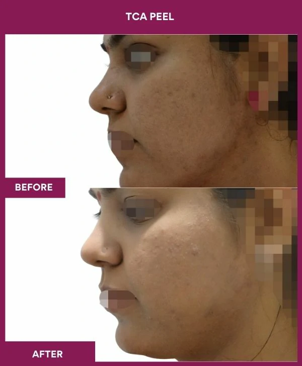 tca-peel-treatment-before-after-results-mumbai-india-patient04-side-left