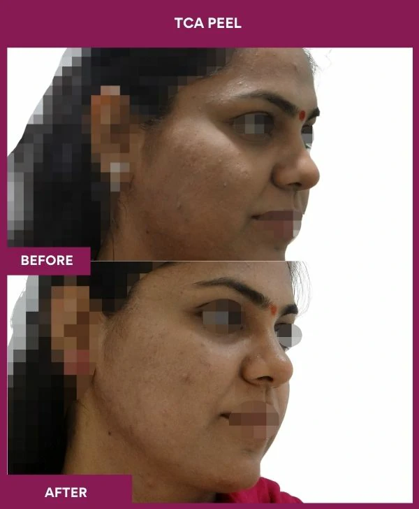 tca-peel-treatment-before-after-results-mumbai-india-patient04-side-right