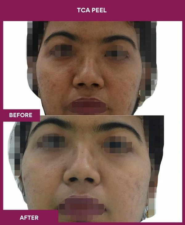 tca-peel-treatment-before-after-results-mumbai-india-patient05-front