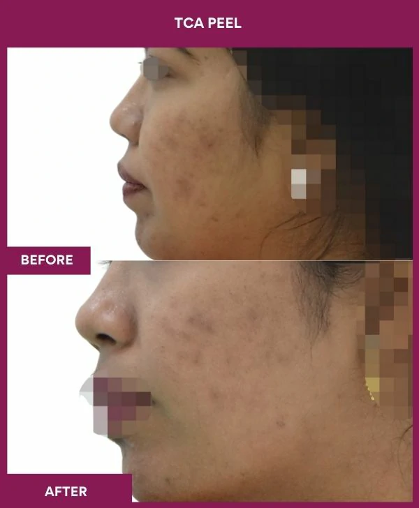 tca-peel-treatment-before-after-results-mumbai-india-patient05-side-left