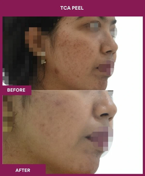 tca-peel-treatment-before-after-results-mumbai-india-patient05-side-right