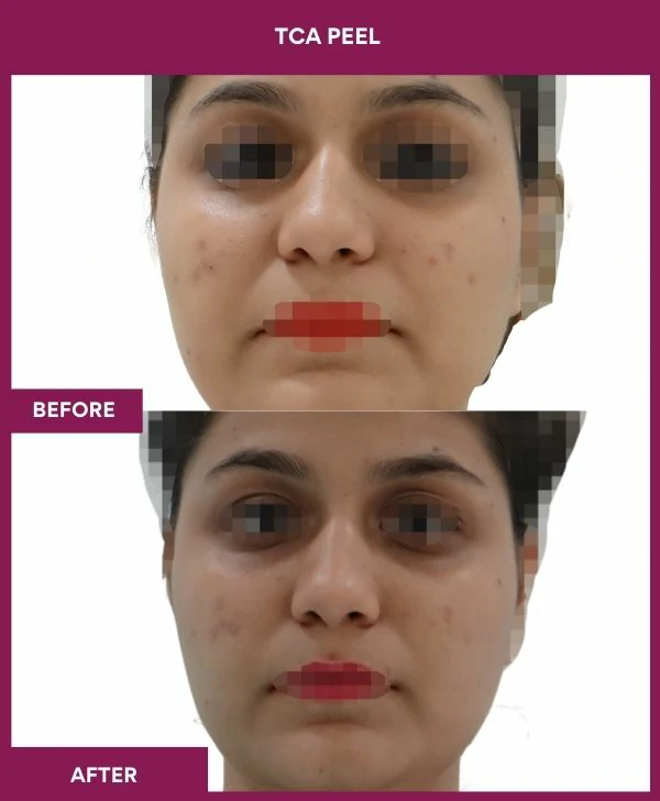 tca-peel-treatment-before-after-results-mumbai-india-patient06-front