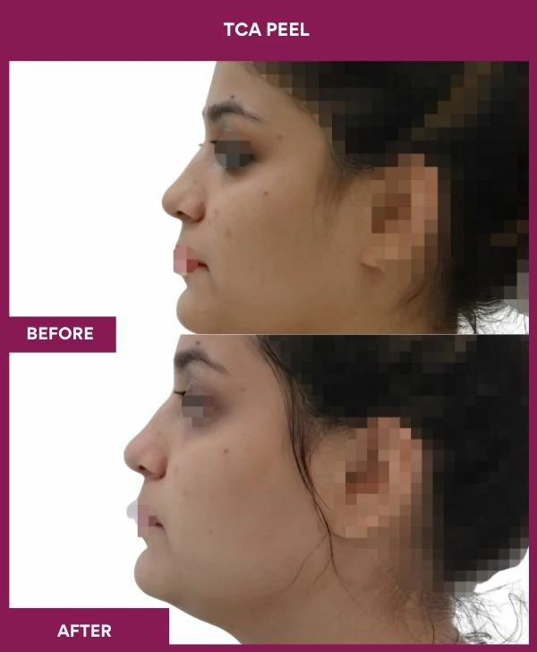 tca-peel-treatment-before-after-results-mumbai-india-patient06-side-left