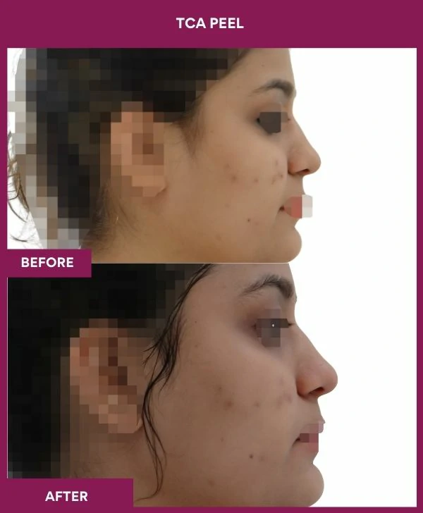 tca-peel-treatment-before-after-results-mumbai-india-patient06-side-right