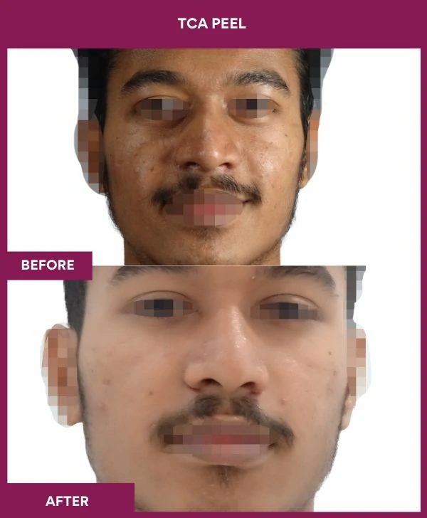 tca-peel-treatment-before-after-results-mumbai-india-patient07-front