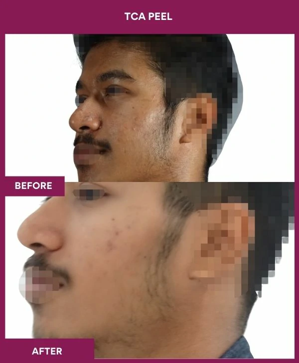 tca-peel-treatment-before-after-results-mumbai-india-patient07-side-left