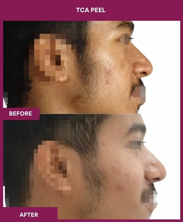 tca-peel-treatment-before-after-results-mumbai-india-patient07-side-right