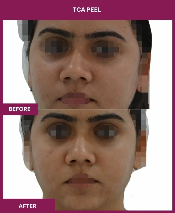 tca-peel-treatment-before-after-results-mumbai-india-patient08-front