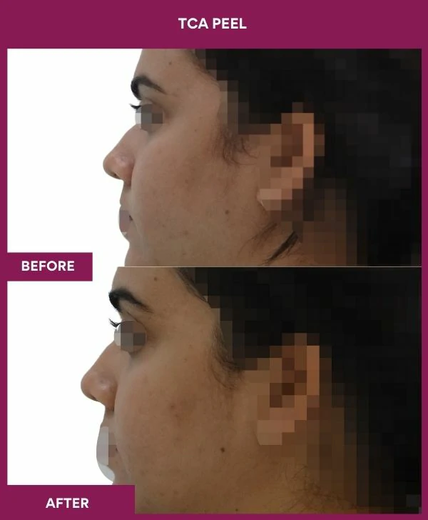tca-peel-treatment-before-after-results-mumbai-india-patient08-side-left