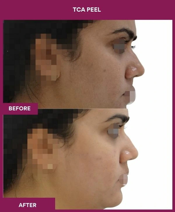tca-peel-treatment-before-after-results-mumbai-india-patient08-side-right