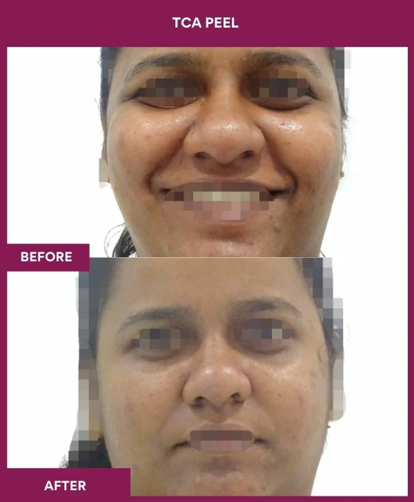 tca-peel-treatment-before-after-results-mumbai-india-patient09-front