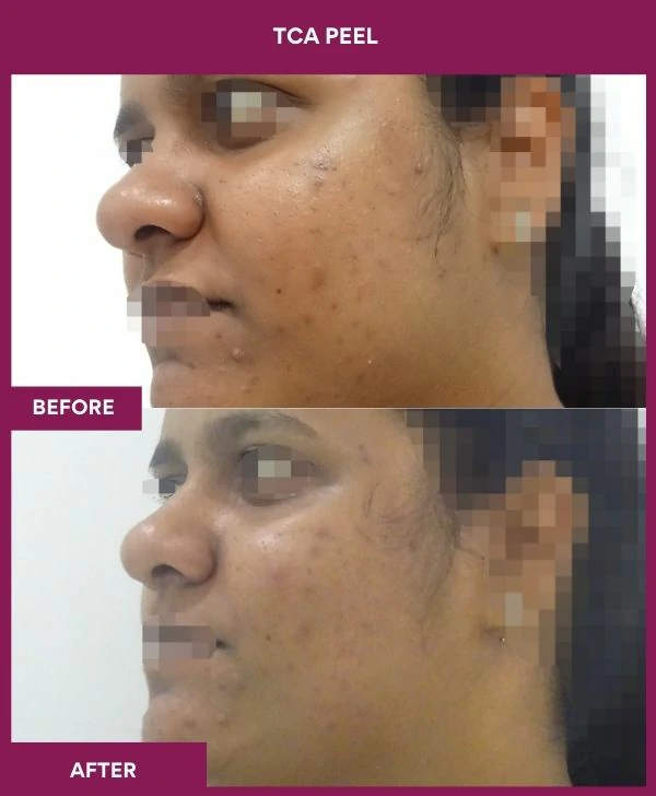 tca-peel-treatment-before-after-results-mumbai-india-patient09-side-left