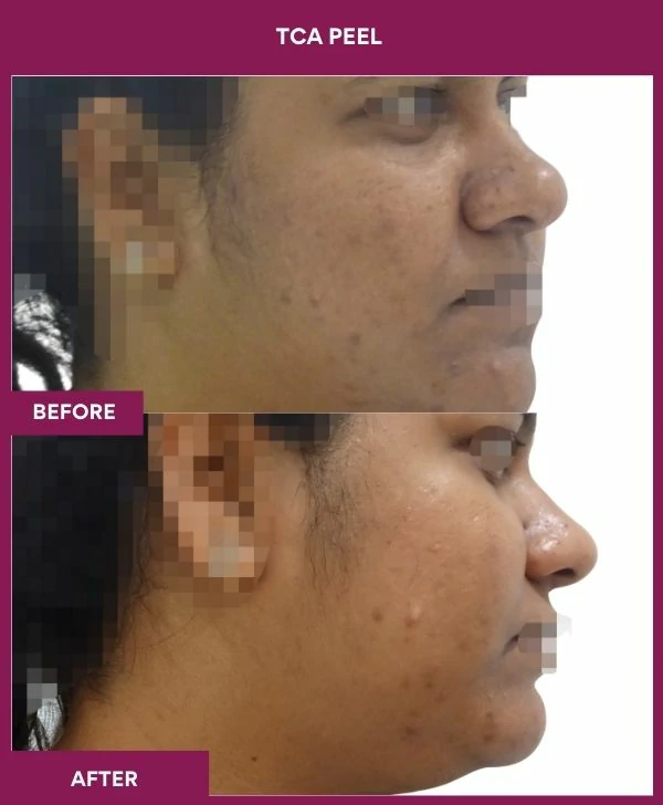 tca-peel-treatment-before-after-results-mumbai-india-patient09-side-right