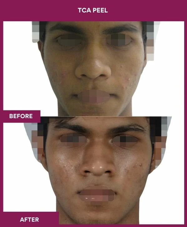 tca-peel-treatment-before-after-results-mumbai-india-patient10-front