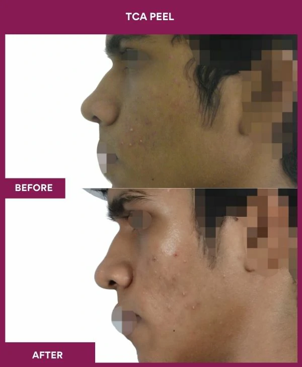 tca-peel-treatment-before-after-results-mumbai-india-patient10-side-left