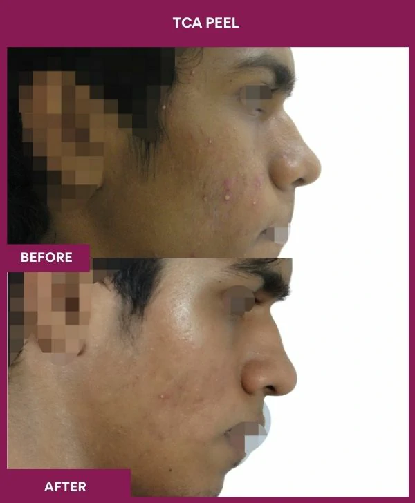 tca-peel-treatment-before-after-results-mumbai-india-patient10-side-right