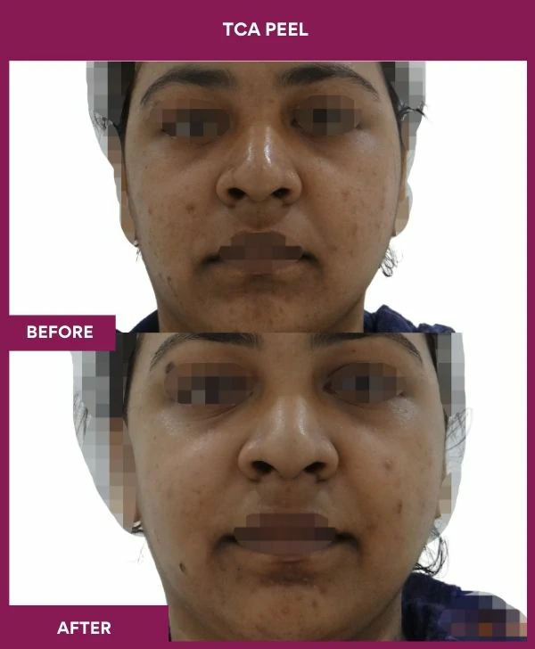 tca-peel-treatment-before-after-results-mumbai-india-patient11-front