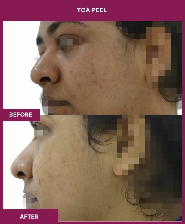 tca-peel-treatment-before-after-results-mumbai-india-patient11-side-left