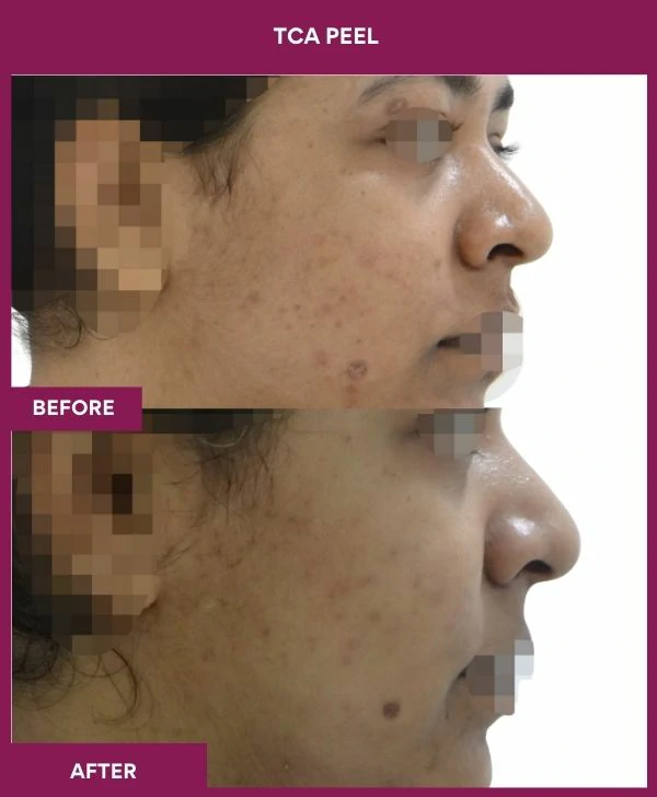 tca-peel-treatment-before-after-results-mumbai-india-patient11-side-right
