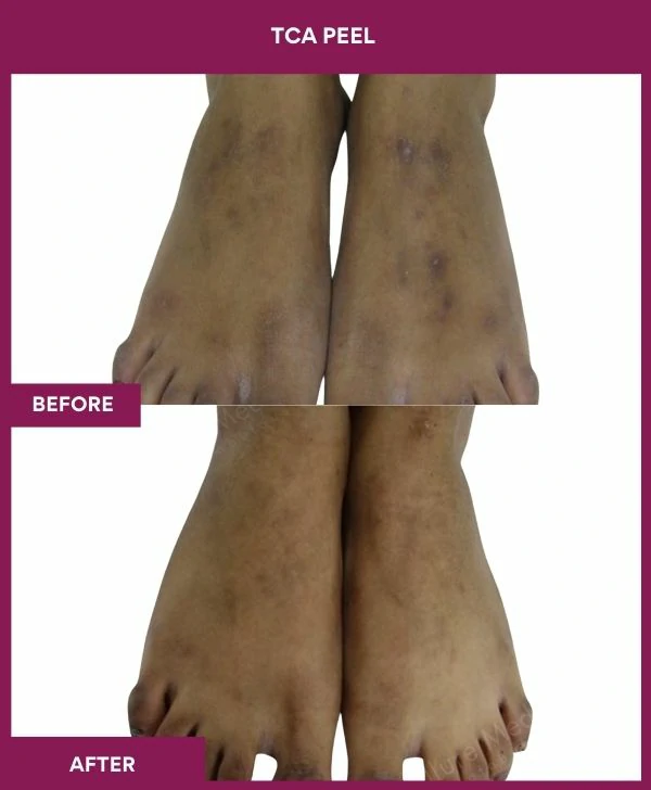 tca-peel-treatment-before-after-results-mumbai-india-patient12-leg