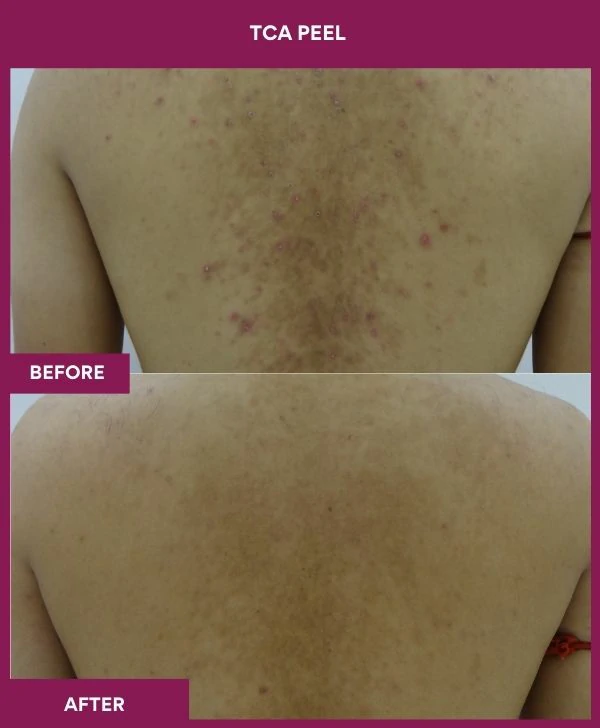 tca-peel-treatment-before-after-results-mumbai-india-patient13-back