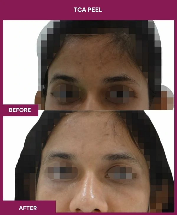 tca-peel-treatment-before-after-results-mumbai-india-patient14-front