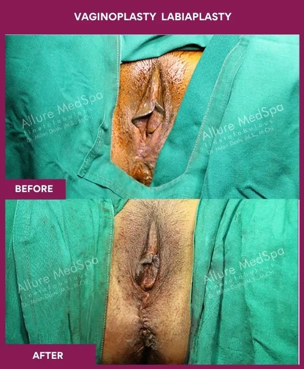 vaginoplasty-and-labiaplasty-before-after-results-mumbai-india-patient03-front-closed