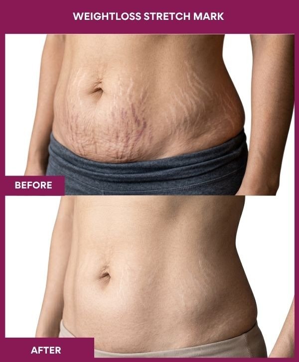 does glutathione pills remove stretch marks Stretch Mark Removal in Mumbai – 4000+ Smooth Skin Results by Dr. Milan  Doshi
