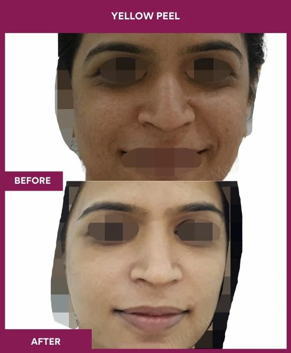 yellow-peel-treatment-before-after-results-mumbai-india-patient01-front