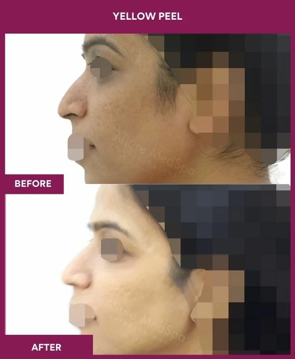 yellow-peel-treatment-before-after-results-mumbai-india-patient01-side-left