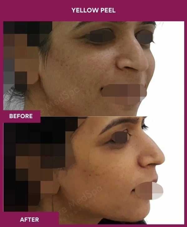 yellow-peel-treatment-before-after-results-mumbai-india-patient01-side-right