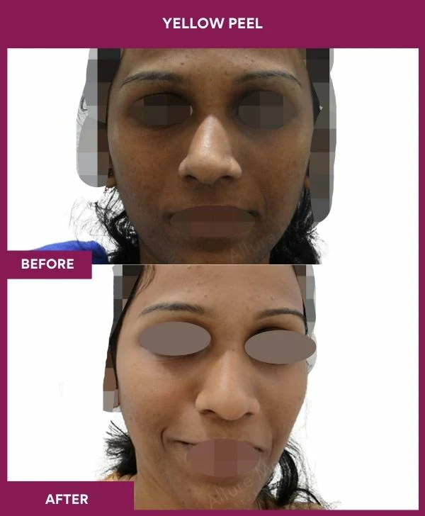 yellow-peel-treatment-before-after-results-mumbai-india-patient02-front