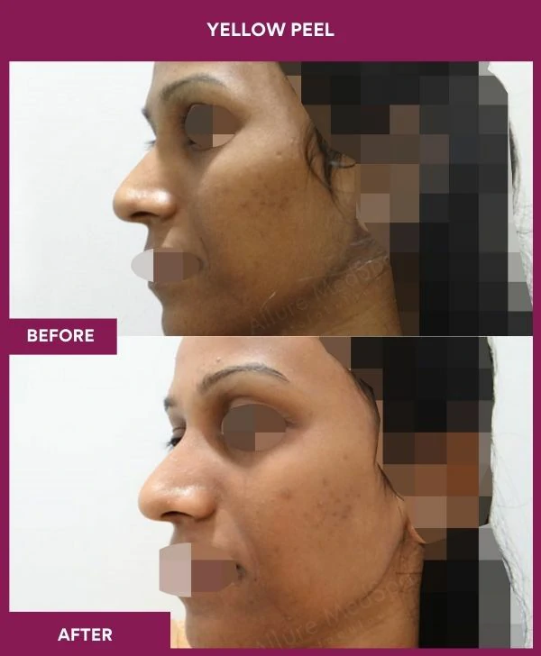 yellow-peel-treatment-before-after-results-mumbai-india-patient02-side-left