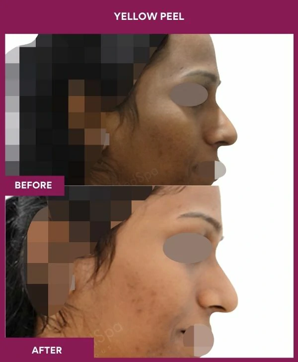 yellow-peel-treatment-before-after-results-mumbai-india-patient02-side-right