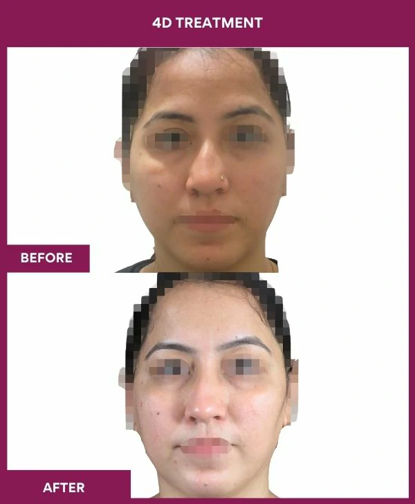 4d-skin-whitening-treatment-before-after-results-mumbai-india-patient01-front