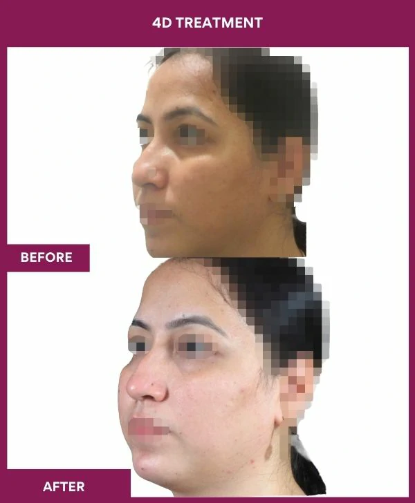 4d-skin-whitening-treatment-before-after-results-mumbai-india-patient01-side-left