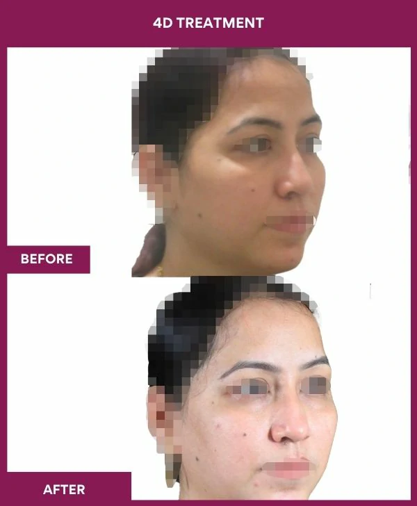 4d-skin-whitening-treatment-before-after-results-mumbai-india-patient01-side-right