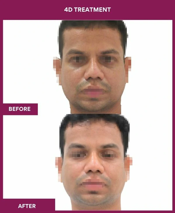 4d-skin-whitening-treatment-before-after-results-mumbai-india-patient02-front