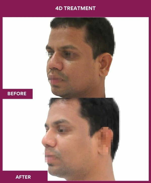 4d-skin-whitening-treatment-before-after-results-mumbai-india-patient02-side-left