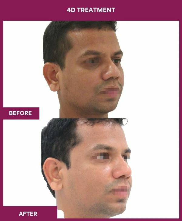 4d-skin-whitening-treatment-before-after-results-mumbai-india-patient02-side-right