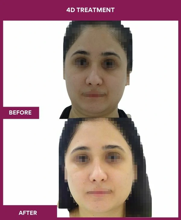 4d-skin-whitening-treatment-before-after-results-mumbai-india-patient03-front