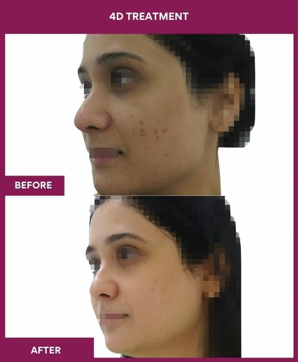 4d-skin-whitening-treatment-before-after-results-mumbai-india-patient03-side-left