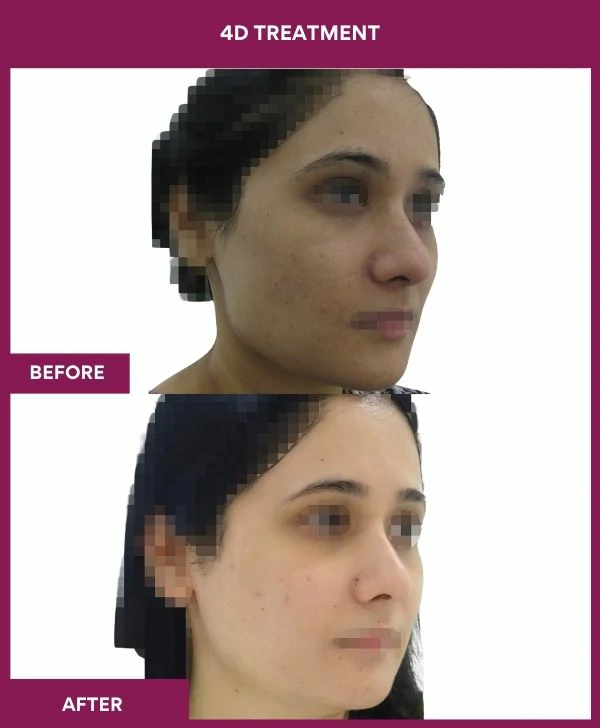 4d-skin-whitening-treatment-before-after-results-mumbai-india-patient03-side-right