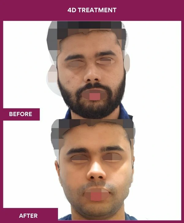 4d-skin-whitening-treatment-before-after-results-mumbai-india-patient04-font