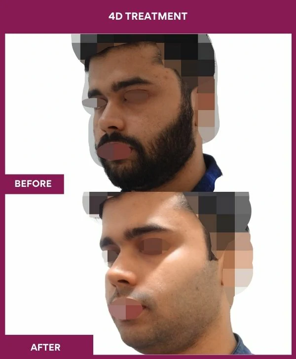 4d-skin-whitening-treatment-before-after-results-mumbai-india-patient04-side-left