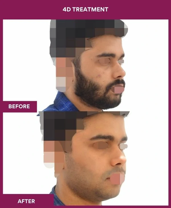4d-skin-whitening-treatment-before-after-results-mumbai-india-patient04-side-right