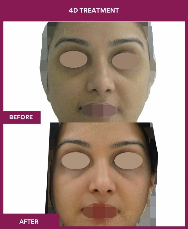 4d-skin-whitening-treatment-before-after-results-mumbai-india-patient05-front