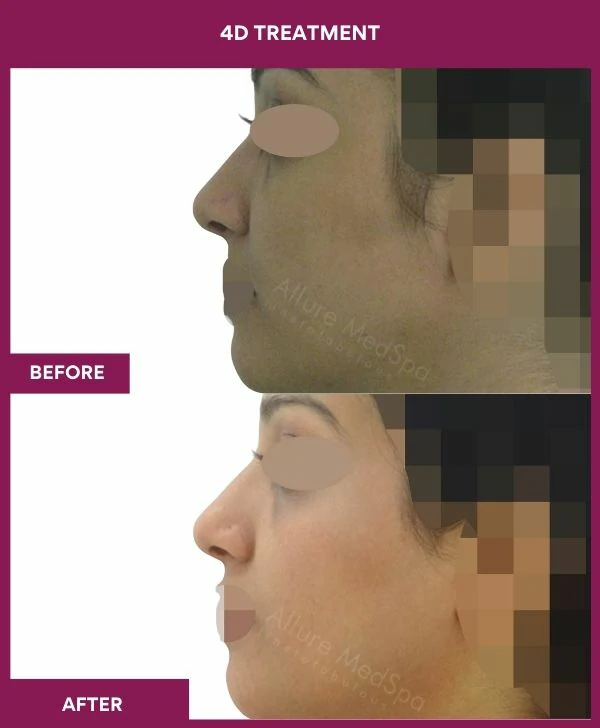 4d-skin-whitening-treatment-before-after-results-mumbai-india-patient05-side-left
