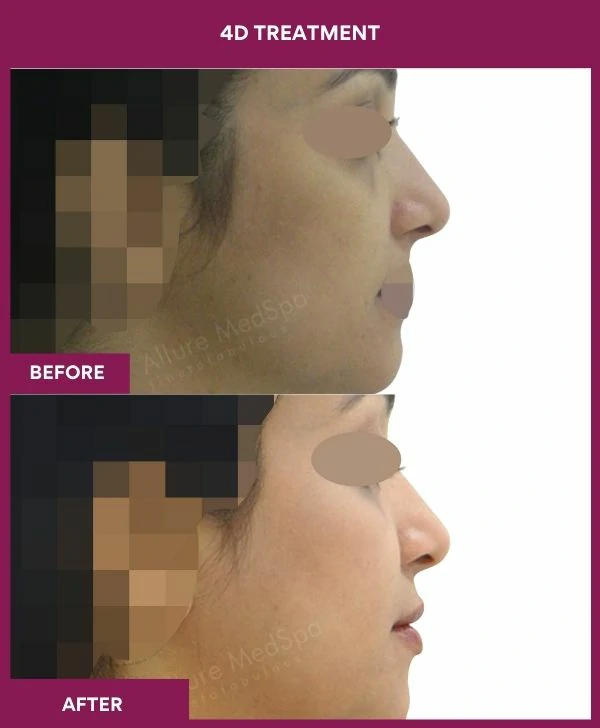 4d-skin-whitening-treatment-before-after-results-mumbai-india-patient05-side-right